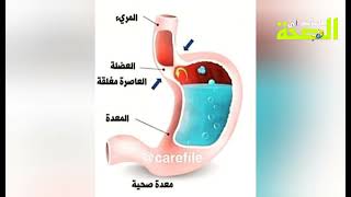 حموضة المعدة