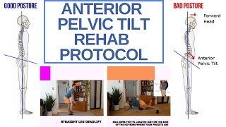 Fix Anterior Pelvic Tilt | Anterior Pelvic Tilt Rehab Program