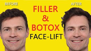 Non-surgical Facelift - Botox Filler Facelift 2020