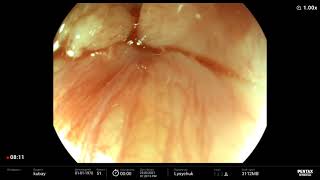 Esophageal cancer/ Рак пищевода