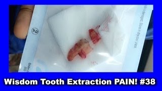 Surgical extraction of horizontally impacted 38. Lower wisdom tooth extraction