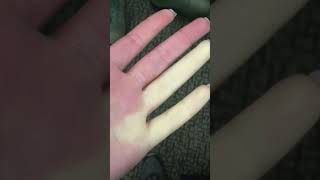 Raynaud's disease short Urdu