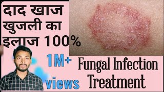 fungal infection treatment । फंगल इनफेक्शन ट्रीटमेंट । पुरानी दाद खाज खुजली का इलाज