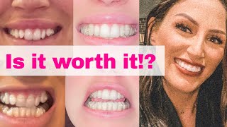 INVISALIGN UPDATE REVIEW / REFINEMENTS/ BEFORE & AFTER 2020