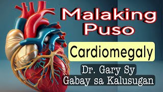 Cardiomegaly: Enlarged Heart - Dr. Gary Sy