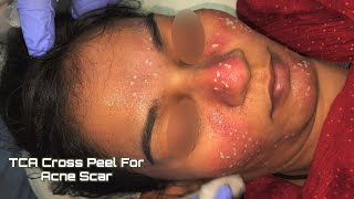 TCA CROSS FOR ACNE SCARS DETAILED VIDEO @DrArifMDDermatologist #acnescartreatment #acnescars #acne