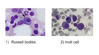 Russell bodies | pathology mbbs 2nd year