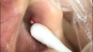 EAR PIMPLE AND BLACKHEADS