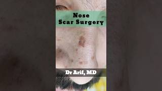 Scar surgery @DrArifMDDermatologist #acnescarremoval #scartreatment