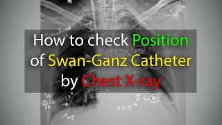 Pulmonary Artery (Swan-Ganz) Catheter position check in Chest X ray