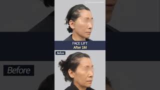 [B&A] Facelift | Plastic Surgery in Korea #shorts