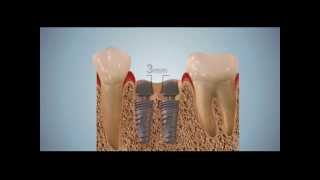 Имплантация при отсутствии 6 зуба