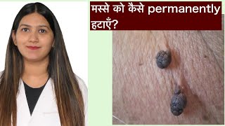 मस्से का permanent इलाज । Skin Tags Removal | मस्से को जड से हटाने के उपाय ।