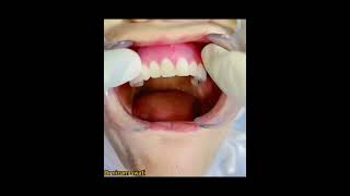 how to pit dental full denture upper and lower