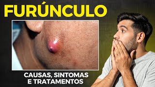 FURÚNCULOS: CAUSAS, SINTOMAS E TRATAMENTOS EFICAZES