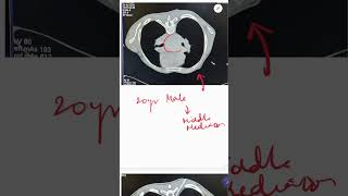 20 y guy with large mediastinal lesion part 1 #shorts