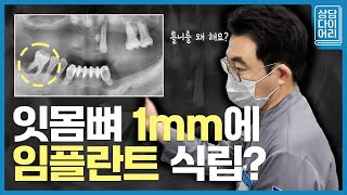 얇은 뼈에 임플란트 심을 수 있는 이유