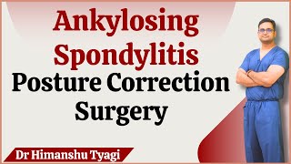 Ankylosing Spondylitis Posture Correction Surgery (kyphosis)| Pedicle subtraction osteotomy (PSO)