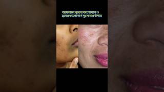 ত্বকের কালো দাগ দূর করার উপায় | dark spot remove #shorts #rupchota