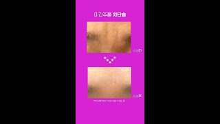 20,30대도 필요한 미간주름차단술 #Shorts