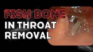 Fish Bone In Throat Removal