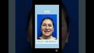 Before and after Facelift and Necklift🙌🏼✨