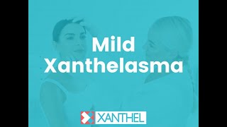 MILD XANTHELASMA -  - Brought To You By XANTHEL ® Easy Mild Xanthelasma Removal !