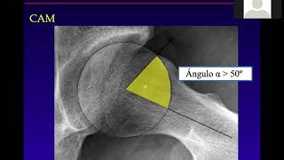 Síndrome Fricción Femoro - Acetabular - Artroscopía de cadera