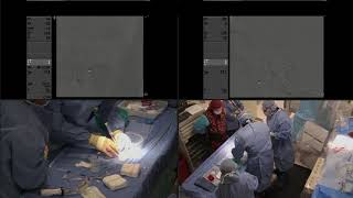 Angioplastia con balón y stenting con Wingspan para estenosis intracranial de la ACL