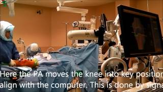 Makoplasty Robotic Knee Replacement