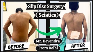 Slip Disc Surgery (Sciatica)  || Sciatica Treatment in Delhi