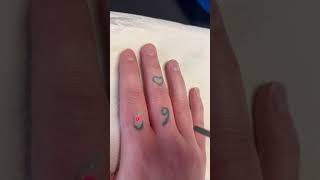 Removing finger  “69” tattoo, ExcelLase