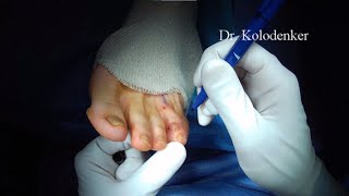 Mucoid Cyst in the toe removed