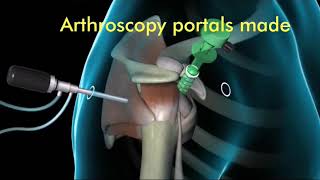 Arthroscopic Bankart Repair (Animation)