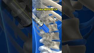 Infiltraciones de ozono para hernia discal. #dolorespalda #biziondo