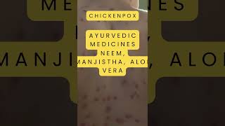 Chickenpox Symptoms | Chickenpox medicine | Chickenpox ayurvedic medicine