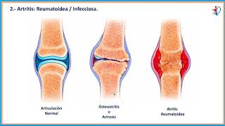 Artritis Clasificación en 4 grupos