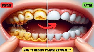 How To Remove Plaque From Teeth | Tartar Removal