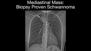 Mediastinal Mass  Biopsy Proven Schwannoma