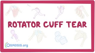 Rotator cuff tear