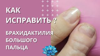 Как избавиться от заболевания ногтей на руках.