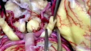 NEUROANATOMÍA 2.0: IRRIGACIÓN DEL SNC 3/3: SISTEMA CAROTIDEO