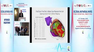 Stereotactic Rdiaion Therapy For Venricular Tachycardia   Dr  Michel E cain