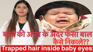 How to remove trapped hair inside newborn baby eye | newborn eye cleaning tips in Hindi |