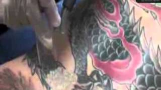 Tattoo Removal, Remove Tattoo, Westwood, (877) 650-7267