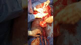 Uterus saving surgery PAS حفاظ علي الرحم مشيمه متقدمة ملتصقه مخترقه مثانه