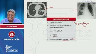 2024 NEUMOLOGÍA   Neumonía  Absceso pulmonar