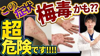 【放置厳禁！！】激増している梅毒の症状・検査・治療・根本的な予防法について泌尿器科専門医が解説します。