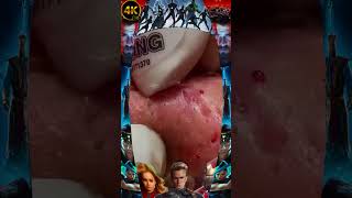 Big Cystic Acne Blackheads Extraction Blackheads & Milia, Whiteheads Removal Pimple Popping #PA217