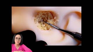 satisfying relaxing asmr video earwax removal.